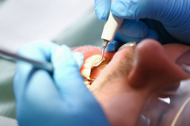 Best Emergency Root Canal Treatment in Hazelwood, MO