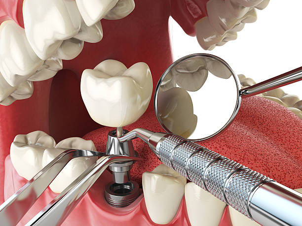Best Emergency Root Canal Treatment in Hazelwood, MO